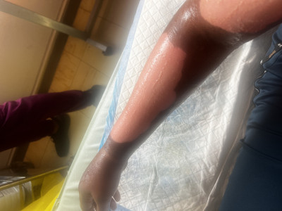 Medical bills for second degree burns