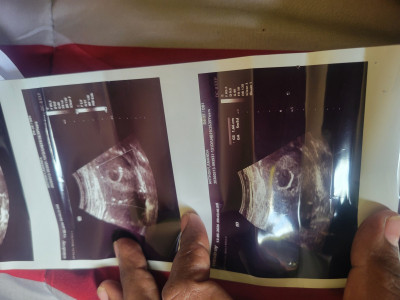 pregnant with lupus