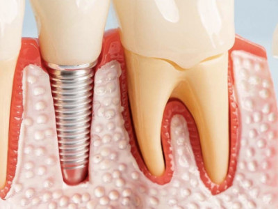 Surgical Teeth implant
