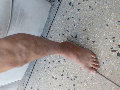 Varicose surgery in legs