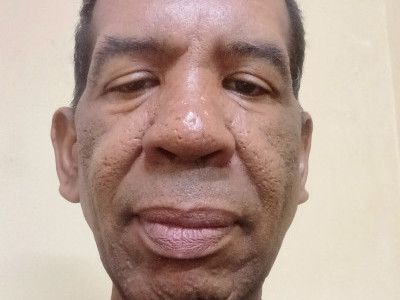 Triple bypass surgery