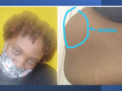 Help Candy George with Medical Costs for Atrial Tachycardia (Heart Arrhythmia) and Hernia