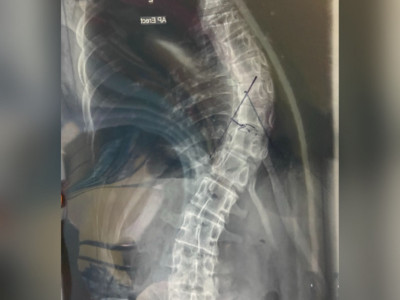 Help Joshua get treatment for Scoliosis!