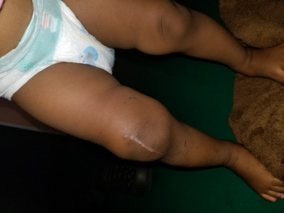 Septic Arthritis