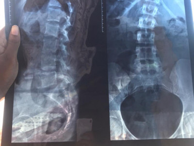 Scoliosis treatment