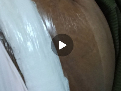 Recoving mum from surgery
