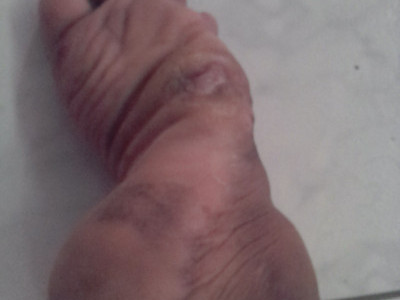 Having a Clubbed foot with a lifetime of ulcers