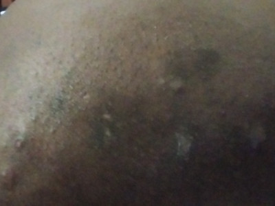 Help to purchase medication for 2nd embolism i recently got in my lungs bloot clots