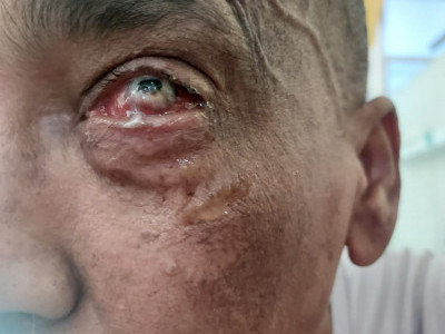 John's fight. Complete Renal Failure and Loss of Left Eye. Medical Assistance Desperately Needed