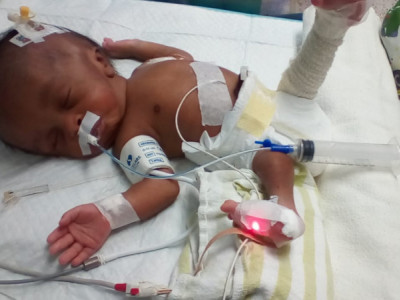 Surgery for Ayden